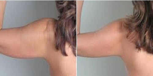Arm correction