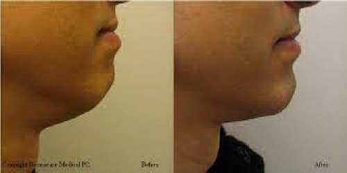 Chin correction