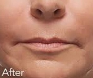 Wrinkle Removal