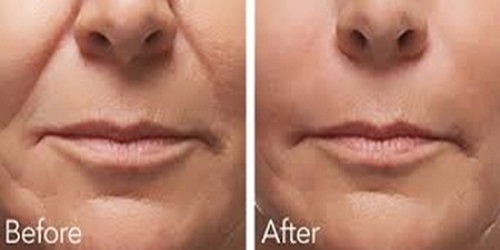 Wrinkle correction